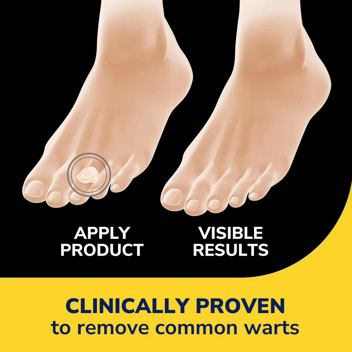 Clear Away Wart Remover Hydrogel Bandages for Dr. Scholl’s (9 Count)